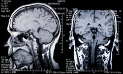 Slidell Brain Injury