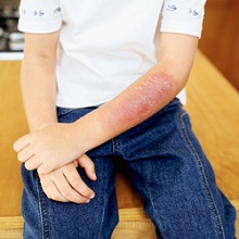 Young Boys Burn Injury