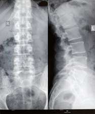 Spinal Cord Back Injuries Xray